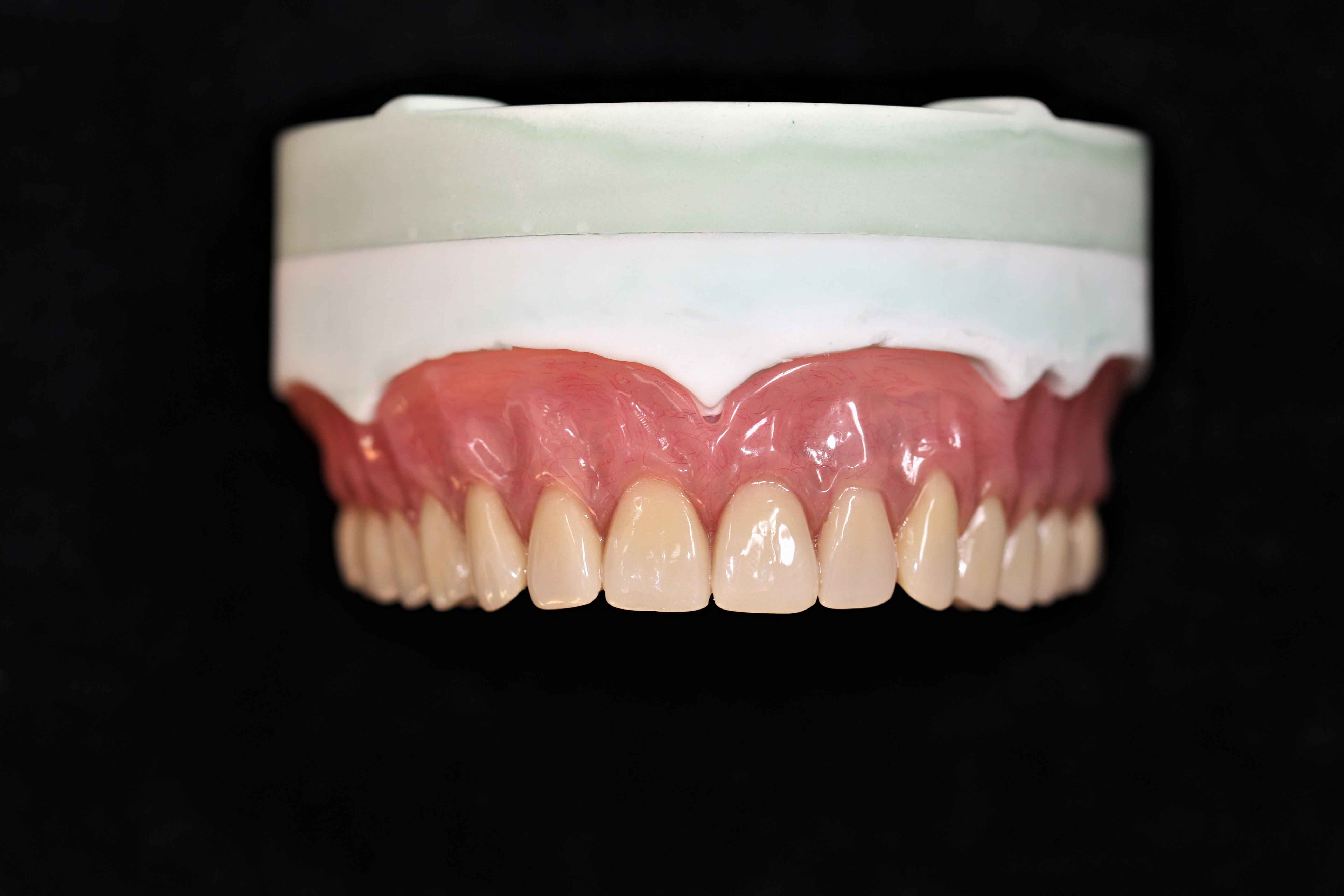 Bestimmung des vertikalen Abstands einer Vollprothese im chinesischen Dentallabor