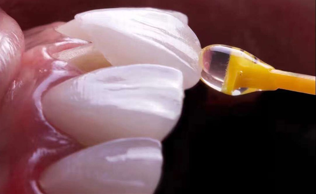 Porzellan-Dentalveneers, IPS e.max-Veneer – ultradünn 0,2 mm, langlebig, natürlich aussehend