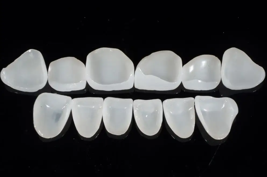 Fallen Porzellanveneers leicht ab?