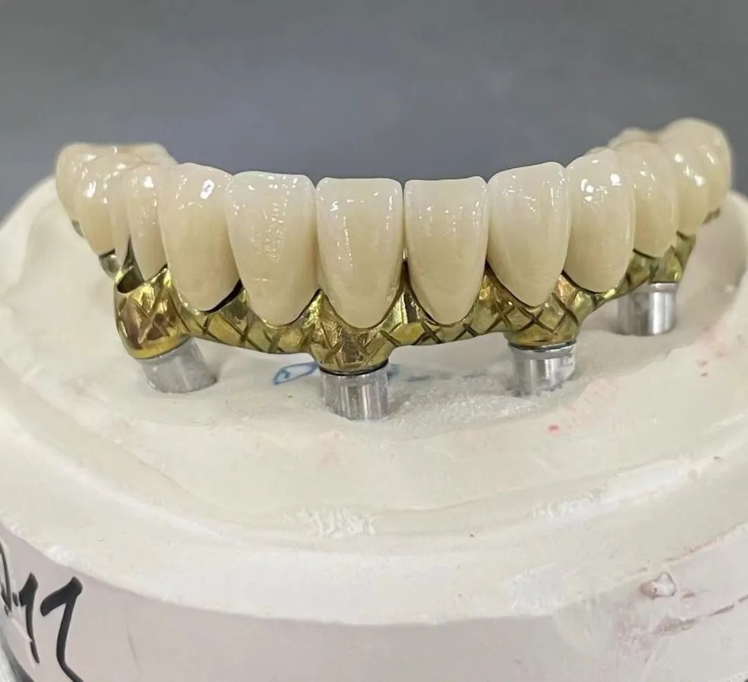 Die Unterschiede zwischen Implantatsteg und Malong-Brücke