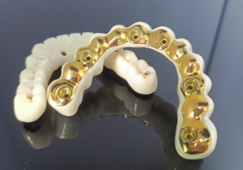 CAD/CAM-Titanimplantatsteg+Zirkonoxidbrücke