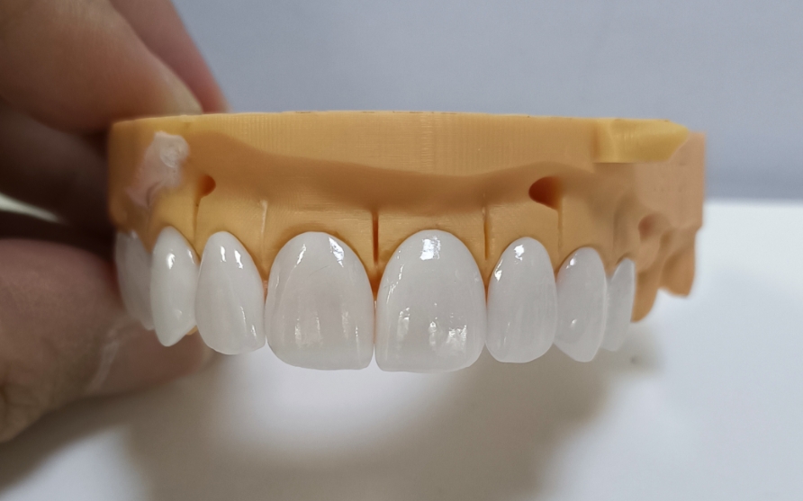 Hochästhetische Emax Veneers