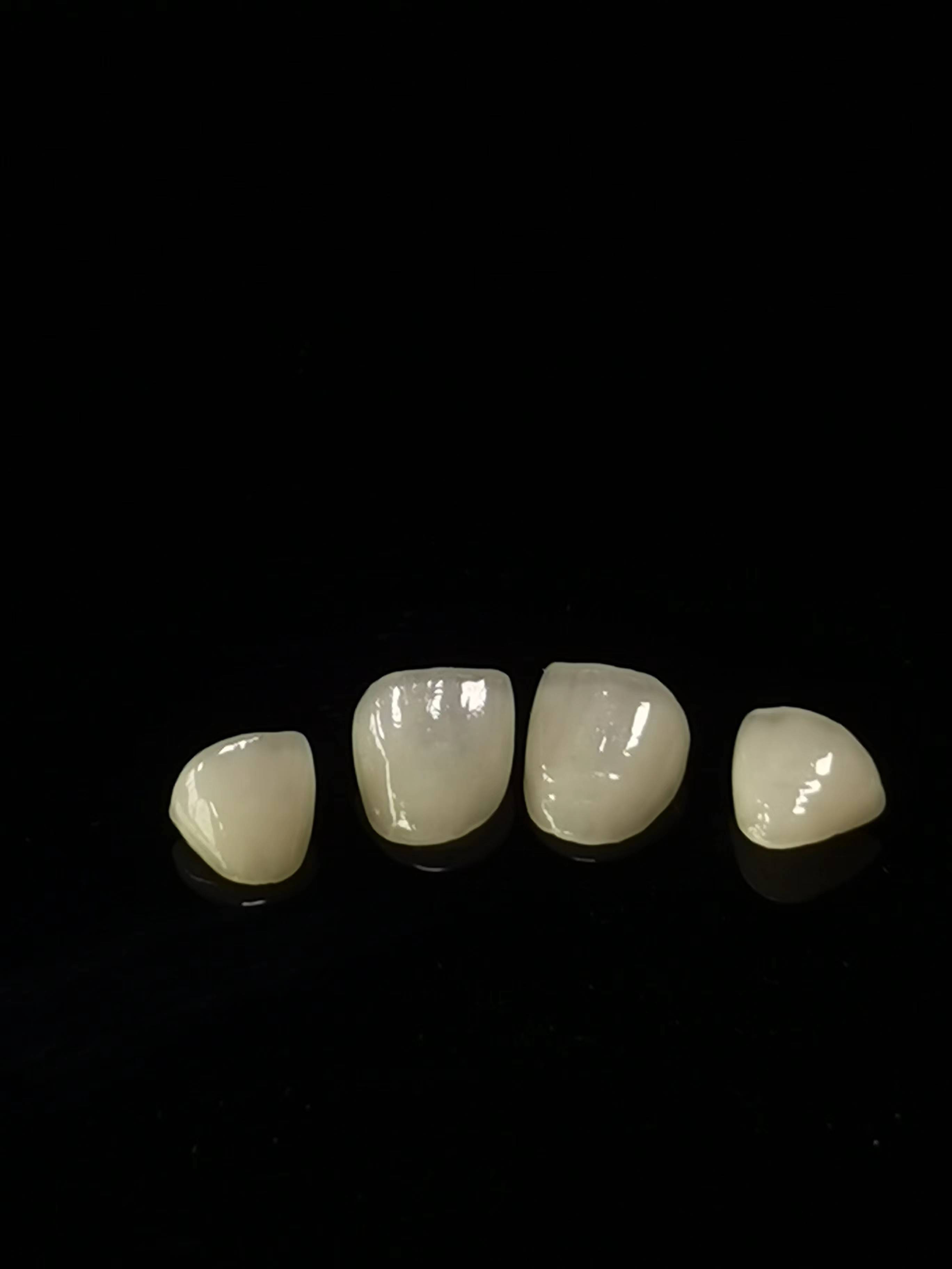 E.max Dentallaborarbeit
