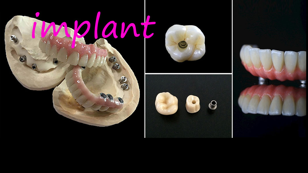 Zahnimplantate