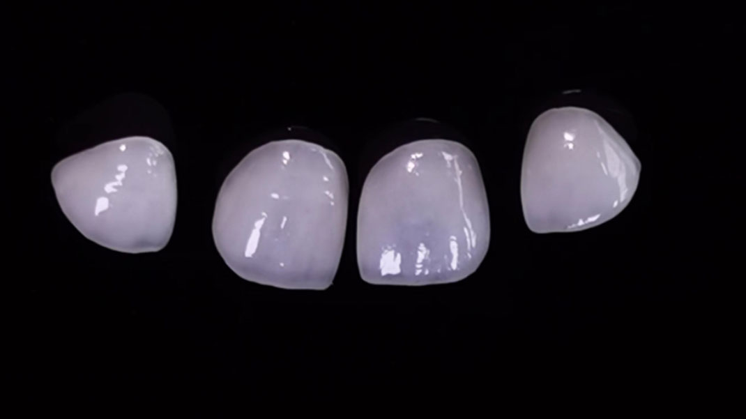 Dentallaminat-Veneers