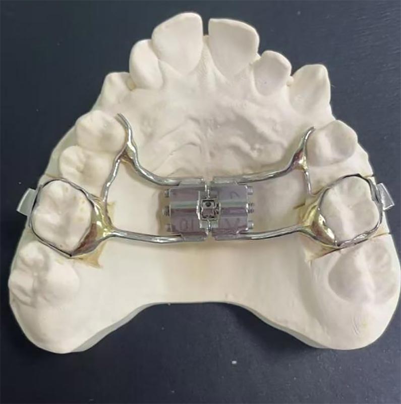Was ist ein schneller Maxillary Expander (RME)?