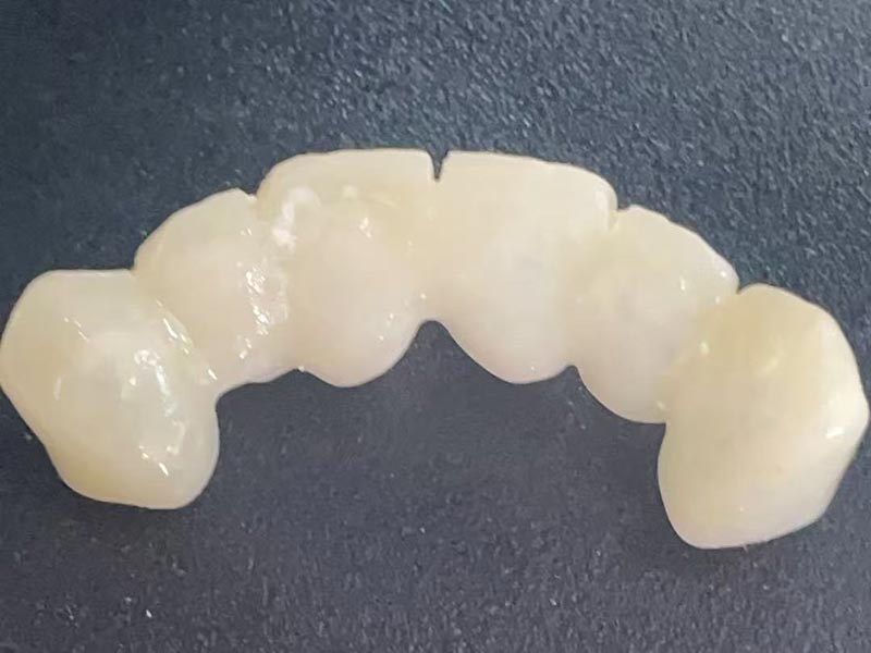 Was ist eine „temporäre Krone“? Warum brauchen Sie einen?