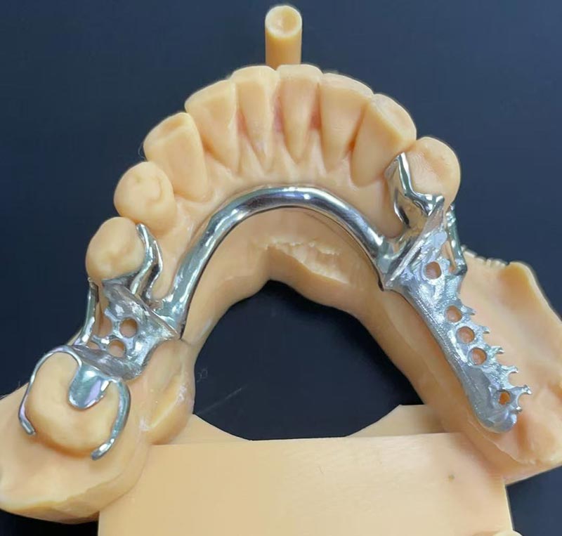 Vorteile des Kobalt-Chrom-Gerüsts (Co-Cr-Gerüst)