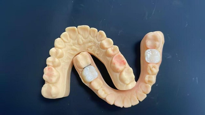 Was ist die Schulterkante?