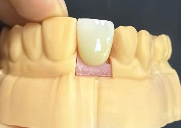 Lücken zwischen den Zähnen können geschlossen werden – gerade Zähne sind am attraktivsten!