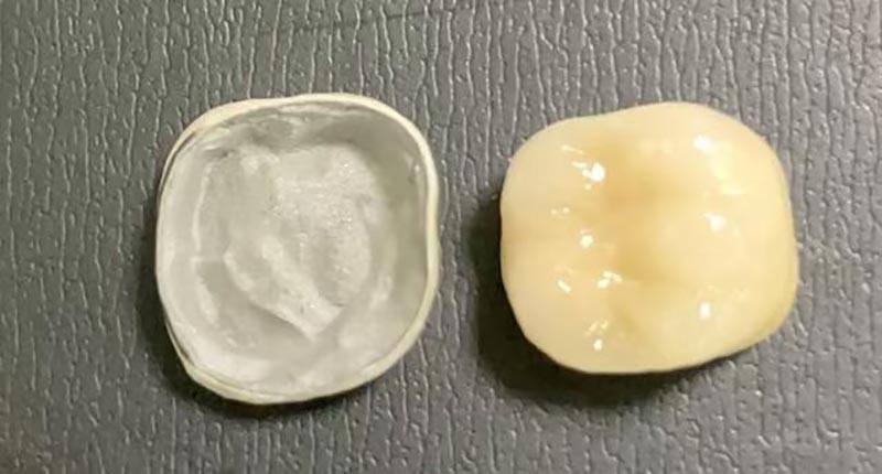 Was tun, wenn Ihre Porzellankrone abplatzt? Hier erfahren Sie, warum es passiert und wie Sie es beheben können