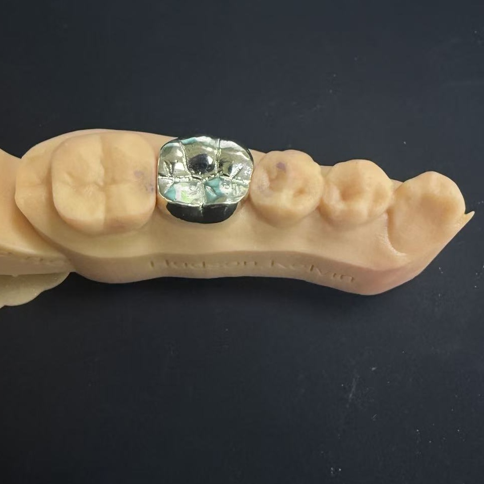 Goldkronen: Die Edelmetallwahl für lebenslange Zahnrestauration