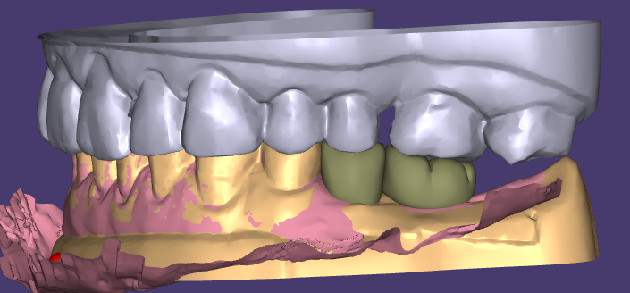 Die ästhetischen Wax-Ups und provisorischen Restaurationen von WM Dental Lab erhalten einhellige Kundenlob