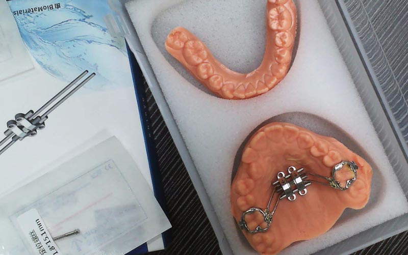 Verstehen Sie die MSE-Skelettexpansion mit WM Dental Lab