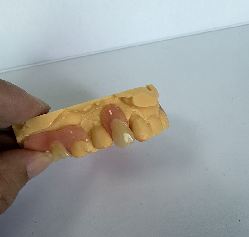 Valplast Partials im WM Dental Lab