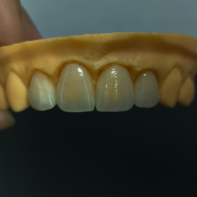 Hochtransluzente Dentalveneers, geschichtetes Emax-Veneer