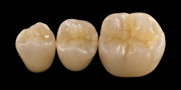<h2>Zirkonoxid in der Zahnheilkunde: Indikationen, Vorteile und klinische Überlegungen</h2>
<p>Zirkonoxid ist weithin für seine Stärke und Haltbarkeit bekannt. Die neuesten Generationen von Zirkonoxidmaterialien bieten zudem deutlich verbesserte ästhetische Eigenschaften. Für Patienten, die vollkeramische Restaurationen in Betracht ziehen, ist es wichtig, sowohl die Indikationen als auch die Einschränkungen von Systemen auf Zirkonoxidbasis sorgfältig abzuwägen.</p>
<p>Heutzutage erwarten Patienten zunehmend Restaurationen, die hervorragende Ästhetik mit voller Funktionalität verbinden. Die meisten modernen Keramiksysteme können diese Erwartungen erfüllen, der klinische Erfolg hängt jedoch weitgehend von der richtigen Materialauswahl, der Zahnvorbereitung und den Zementierungsprotokollen ab. Bei der Auswahl sollten wichtige Materialeigenschaften wie Bruchfestigkeit, Biegefestigkeit, Verschleißfestigkeit und Langzeitstabilität berücksichtigt werden. Unter diesen Materialien ist Zirkonoxid zu einer der am häufigsten verwendeten Optionen in der modernen restaurativen Zahnheilkunde geworden.</p>
<h3>Warum Zirkonoxid wählen?</h3>
<p>Zirkonoxid wird wegen seiner außergewöhnlichen Festigkeit und Langzeitbeständigkeit geschätzt. Modernes Zirkonoxid unterscheidet sich deutlich von früheren Generationen, die undurchsichtiger und weniger ästhetisch waren. Heute ermöglicht die CAD/CAM-Technologie die präzise Herstellung von Zirkonoxid-Restaurationen mit verbesserten optischen Eigenschaften.</p>
<p>Restaurationen können wie folgt gestaltet werden:</p>
<ul>
<li><strong>Monolithisches Zirkonoxid:</strong>Ideal für Kronen und Brücken im Seitenzahnbereich und bietet hohe Festigkeit und Haltbarkeit.</li>
<li><strong>Schichtzirkonia:</strong>Geeignet für Fälle, die eine verbesserte Ästhetik erfordern, einschließlich langspanniger Restaurationen in verschiedenen Bereichen des Mundes.</li>
</ul>
<p>Die Biegefestigkeit variiert je nach Typ und reicht von etwa 590 MPa bei hochtransluzentem Zirkonoxid bis zu 1400 MPa bei monolithischen Formen. Zirkonoxidrestaurationen können mit selbstadhäsiven Kunststoffzementen oder harzmodifizierten Glasionomerzementen befestigt werden.</p>
<h3>Schlüsselfaktoren bei der Auswahl des Zirkonoxidmaterials</h3>
<p>Wenn Zahnärzte Zirkonoxid für eine vollkeramische Restauration in Betracht ziehen, sollten sie mehrere kritische Faktoren berücksichtigen:</p>
<ul>
<li>Verbleibende Zahnsubstanz</li>
<li>Lage in der Mundhöhle (ästhetische Zone vs. funktionelle Zone)</li>
<li>Vorhandensein parafunktioneller Gewohnheiten wie Bruxismus</li>
<li>Transluzenz benachbarter natürlicher Zähne</li>
<li>Farbe und Zustand der darunter liegenden Zahnstruktur</li>
</ul>
<p>Die ästhetische Zone umfasst typischerweise die Frontzähne, kann sich jedoch bei manchen Patienten je nach Lachlinie und Gesichtsdynamik bis zum ersten Molaren erstrecken. Die Funktionszone umfasst im Allgemeinen Prämolaren und Molaren, in denen die Okklusionskräfte deutlich höher sind.</p>
<h3>Funktionszonenanwendungen</h3>
<p>Im Seitenzahnbereich müssen die okklusalen Kräfte sorgfältig berücksichtigt werden. Zirkonoxid ist eine hervorragende Alternative zu herkömmlichen PFM-Restaurationen, insbesondere in Fällen mit begrenztem restaurativem Platz. Modernes monolithisches Zirkonoxid ermöglicht die vollkonturige Gestaltung der okklusalen Anatomie, einschließlich funktioneller Höcker und Randleisten, bei gleichzeitiger Beibehaltung einer hohen Festigkeit.</p>
<p>Aktuelle Erkenntnisse zeigen, dass monolithisches Zirkonoxid aufgrund seiner hervorragenden Bruch- und Verschleißfestigkeit gut für Seitenzahnkronen und mehrgliedrige Brücken geeignet ist. Fortschritte in der Klebetechnik und im Präparationsdesign haben auch die langfristigen klinischen Ergebnisse verbessert.</p>
<h3>Anwendungen im ästhetischen Bereich</h3>
<p>Im Frontzahnbereich müssen Restaurationen die natürliche Zahnfarbe, Transluzenz und das Lichtverhalten möglichst genau nachbilden. Während Materialien wie Lithiumdisilikat eine hervorragende Ästhetik bieten, sind sie weniger stark und erfordern typischerweise eine Klebebindung.</p>
<p>Ein wesentlicher Vorteil von Zirkonoxid ist seine Fähigkeit, konventionell zementiert zu werden und gleichzeitig eine hohe ästhetische Leistung zu erzielen. Mit der Entwicklung hochtransluzenter und mehrschichtiger Zirkonoxidsysteme ist es nun möglich, Restaurationen herzustellen, die dem natürlichen Gebiss sehr nahe kommen.</p>
<p>Fortschrittliche Verarbeitungstechniken verbessern die optischen Eigenschaften weiter und reduzieren Unvollkommenheiten, die die Lichtdurchlässigkeit und das Erscheinungsbild beeinträchtigen können.</p>
<h3>Stärke und Ästhetik vereint</h3>
<p>Frühe Zirkonoxidsysteme legten zwar Wert auf Festigkeit, es mangelte ihnen jedoch an ästhetischer Qualität. Modernes monolithisches Zirkonoxid kombiniert erfolgreich Festigkeit und verbessertes Erscheinungsbild und eignet sich daher für eine Vielzahl klinischer Fälle.</p>
<p>Es ist besonders vorteilhaft für Patienten mit parafunktionellen Gewohnheiten oder früheren Wiederherstellungsfehlern. Klinische Studien belegen eine hohe Patientenakzeptanz und niedrige Komplikationsraten.</p>
<p>Bedenken hinsichtlich der Abnutzung des Gegengebisses wurden durch neuere Formulierungen verringert. Hochglanzpolierte Zirkonoxidoberflächen weisen ein geringes abrasives Potenzial auf und sind in manchen Fällen möglicherweise schonender als herkömmliche mit Metall verschmolzene Restaurationen aus Porzellan.</p>
<h3>Zirkonimplantate: Neue Alternative</h3>
<p>Während Titanimplantate nach wie vor der klinische Standard sind, gewinnen Zirkonoxidimplantate als metallfreie Alternative zunehmend an Bedeutung. Frühere Designs waren hauptsächlich einteilige Systeme, aber zweiteilige Zirkonimplantate ermöglichen heute eine verbesserte prothetische Flexibilität.</p>
<p>Zirkonimplantate sind besonders nützlich in Fällen, in denen ästhetische Bedenken bestehen, wie z. B. eine mögliche graue Verfärbung des periimplantären Gewebes oder ein dünner Zahnfleischbiotyp. Sie können auch bei Patienten mit seltener Titanempfindlichkeit in Betracht gezogen werden.</p>
<p>Allerdings sind Zirkonimplantate noch relativ neu und die langfristigen klinischen Daten sind im Vergleich zu Titansystemen noch begrenzt.</p>
<h3>Abschluss</h3>
<p>Zirkonoxid hat sich zu einem äußerst vielseitigen Material in der restaurativen Zahnheilkunde entwickelt und bietet ein starkes Gleichgewicht zwischen mechanischer Leistung und Ästhetik. Um optimale Ergebnisse sowohl bei anterioren als auch bei posterioren Anwendungen zu erzielen, sind die richtige Fallauswahl und die Einhaltung klinischer Protokolle von entscheidender Bedeutung.</p>