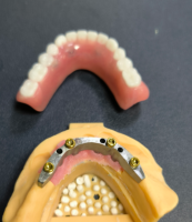 Locator und Dentalschiene