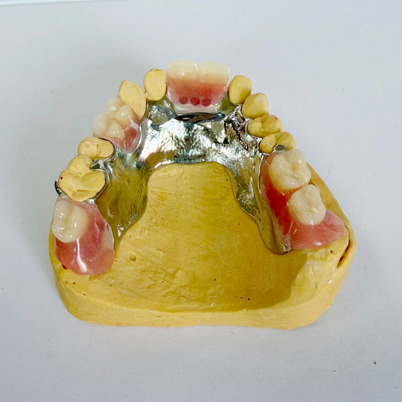 Abnehmbares Restaurations-Teilgerüst